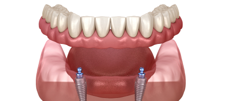 implant-retained dentures