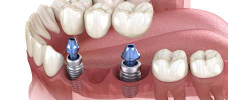 implant-supported bridges