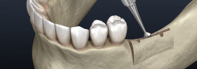 ridge augmentation