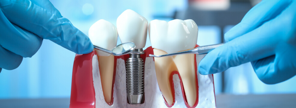 single-tooth dental implant