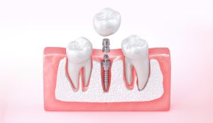 osseointegration of dental implant