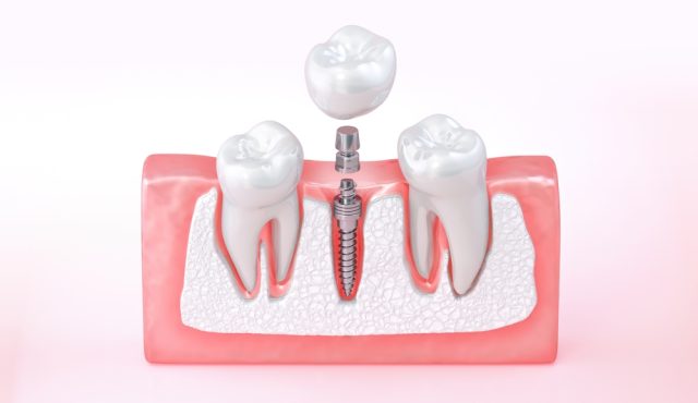 osseointegration of dental implant