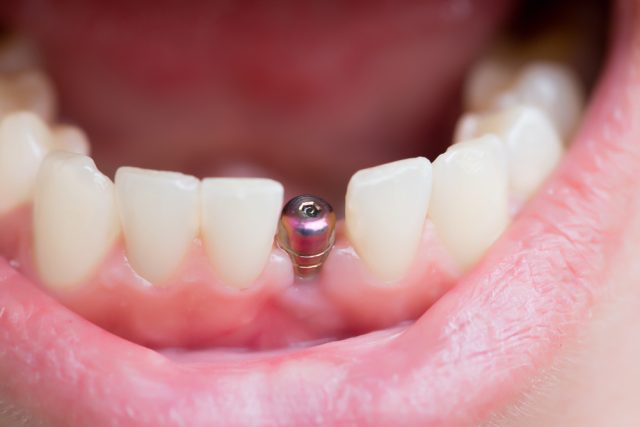 mouth with dental implant, no crown